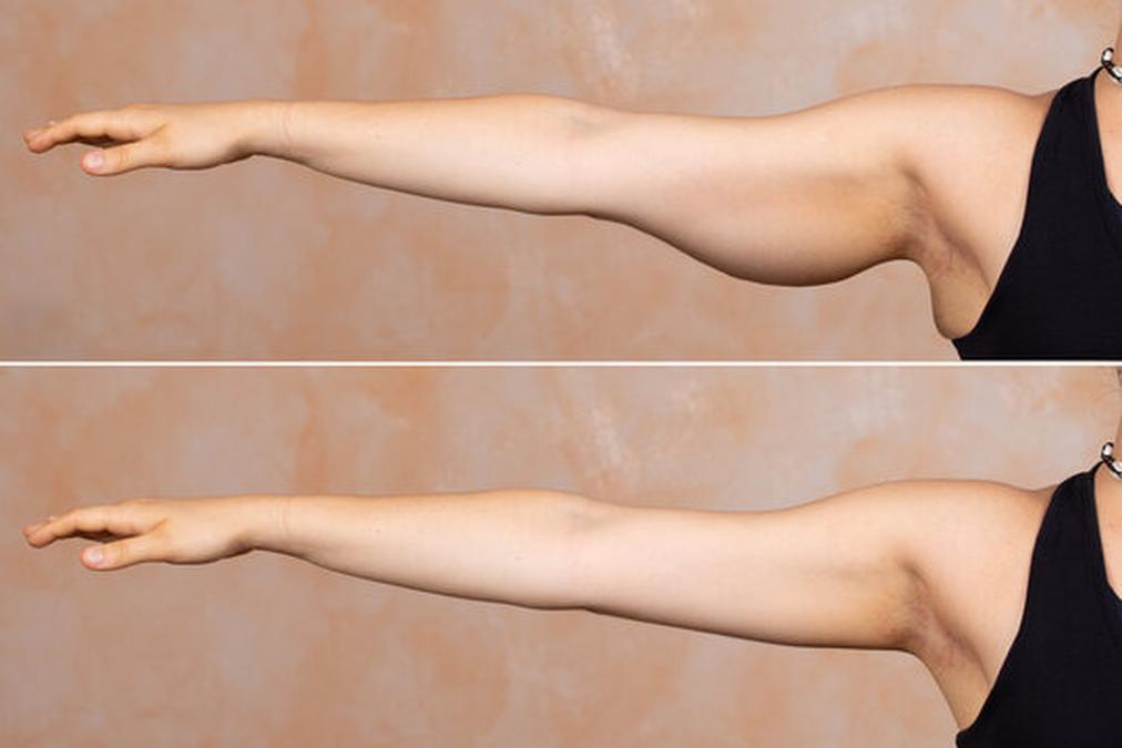 Before and after view of a young Caucasian lady who had an arm lift surgery called Brachioplasty - a